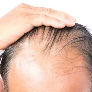 closeup old man serious hair loss problem and gray for health care shampoo and beauty product concept t20 Xz74O9